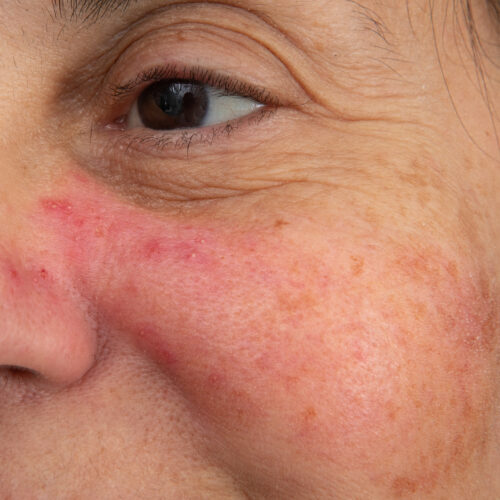 A case of early rosacea on a woman's face.